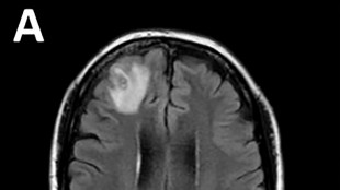 M&eacute;dicos australianos hallan por primera vez una lombriz par&aacute;sita en el cerebro de una mujer